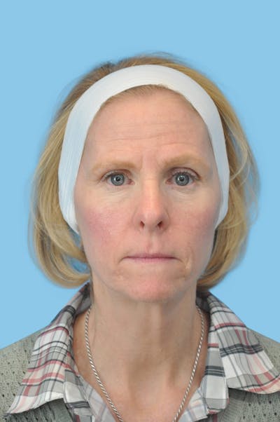 Facelift & Necklift Before & After Gallery - Patient 180905 - Image 1