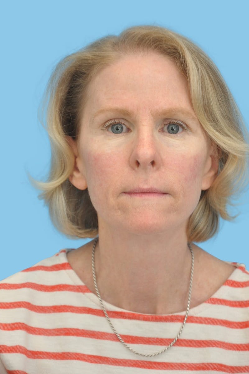 Facelift & Necklift Before & After Gallery - Patient 180905 - Image 2