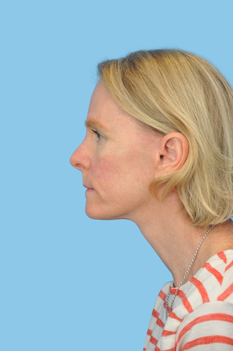 Facelift & Necklift Before & After Gallery - Patient 180905 - Image 4