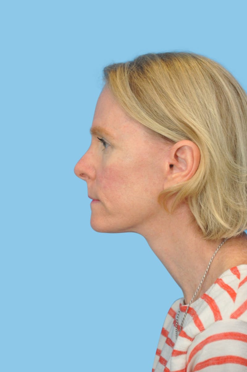 SWIFT LIFT ® / Facelift / Necklift  Before & After Gallery - Patient 180905 - Image 4