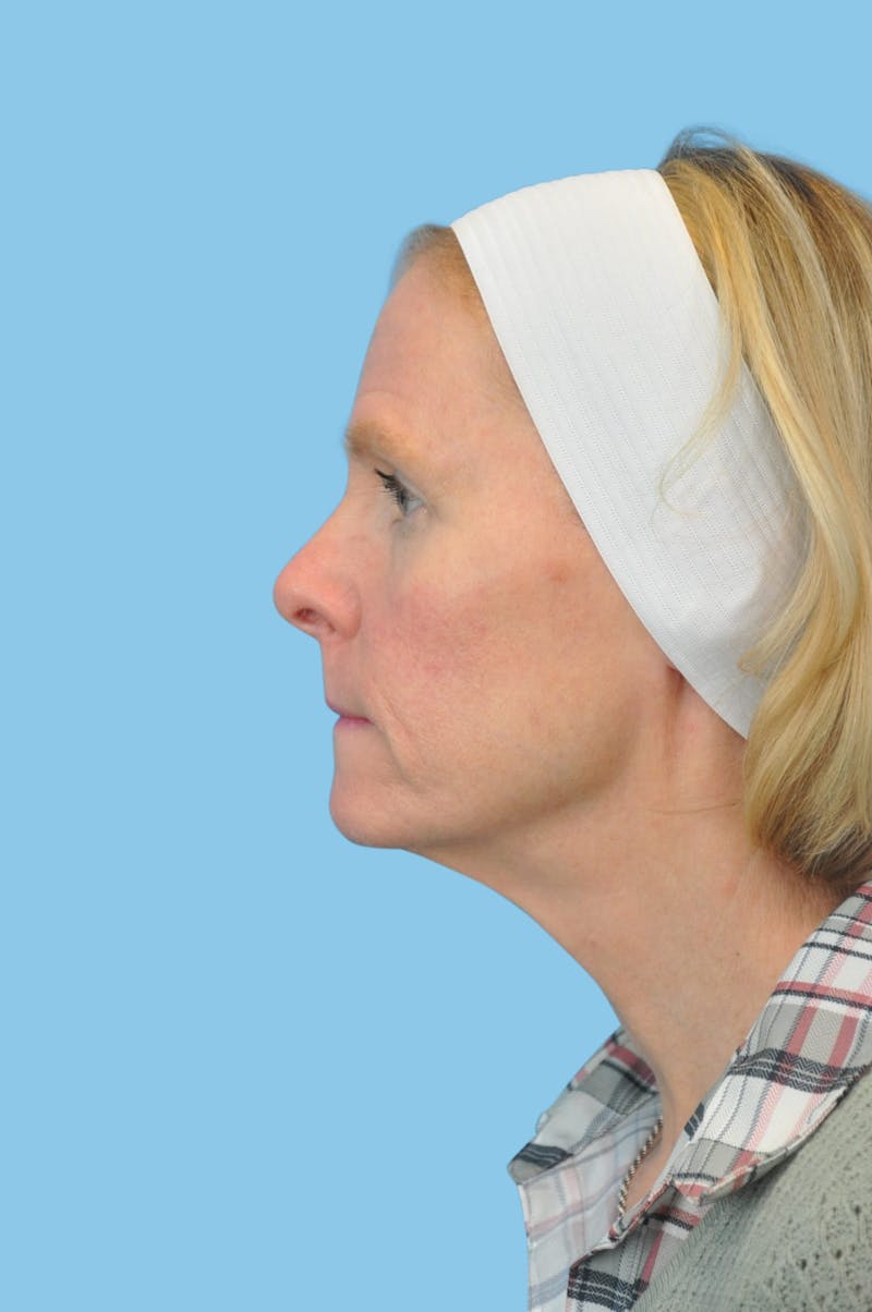SWIFT LIFT ® / Facelift / Necklift  Before & After Gallery - Patient 180905 - Image 3