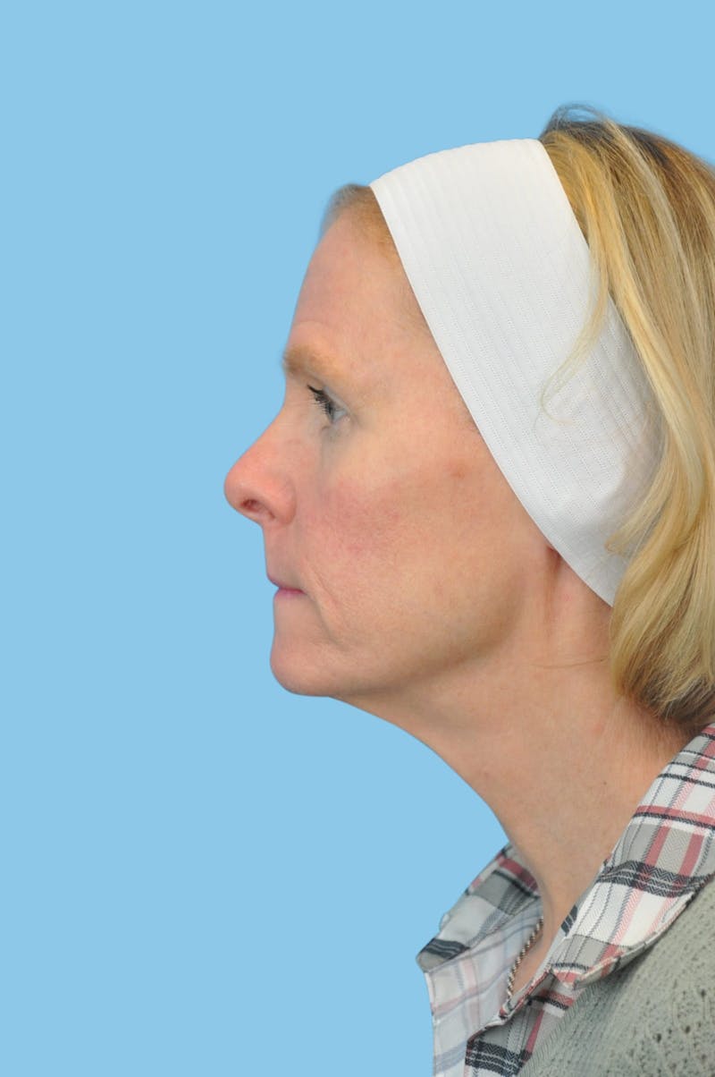 Facelift & Necklift Before & After Gallery - Patient 180905 - Image 3