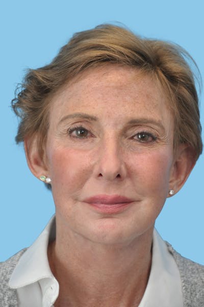 SWIFT LIFT ® / Facelift / Necklift  Before & After Gallery - Patient 765514 - Image 1