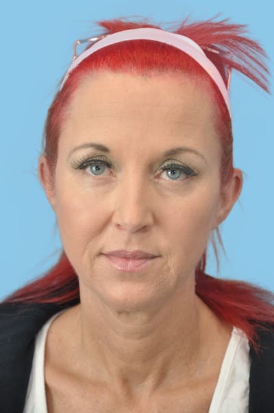 Facelift & Necklift Before & After Gallery - Patient 193546 - Image 1