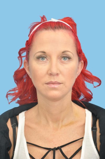 SWIFT LIFT ® / Facelift / Necklift  Before & After Gallery - Patient 193546 - Image 2