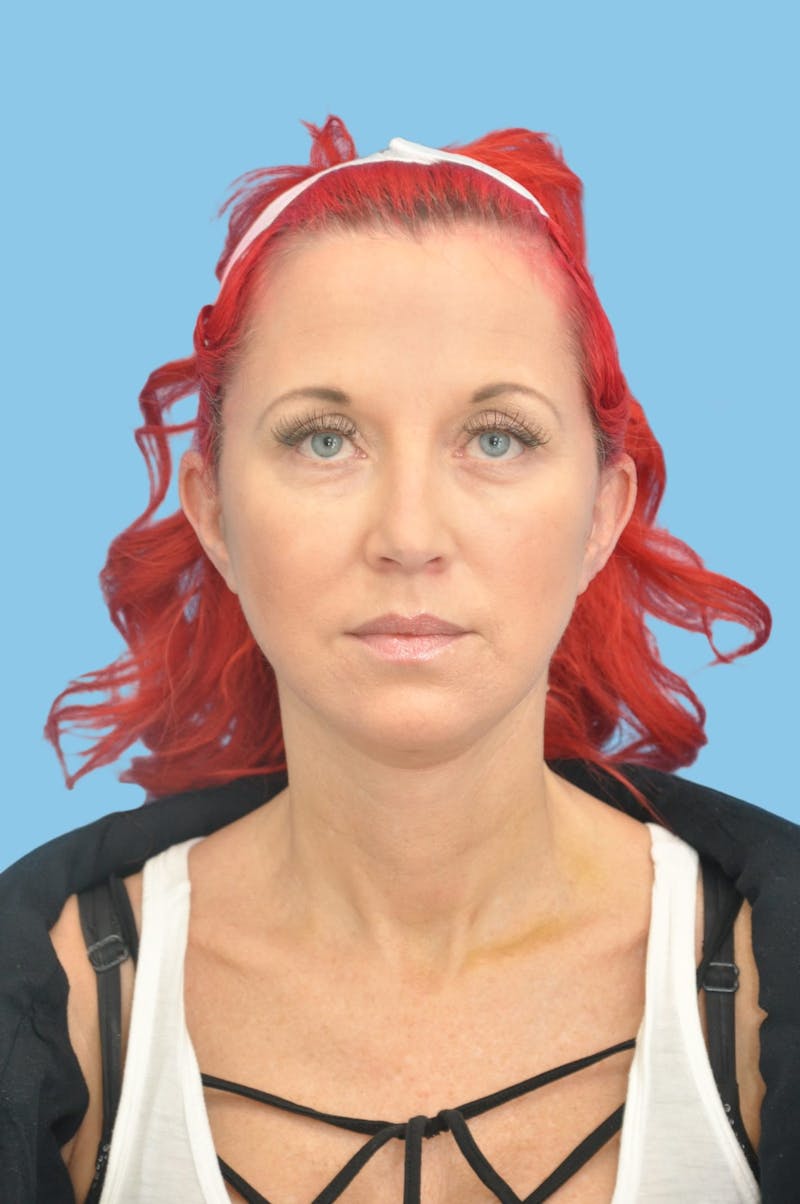SWIFT LIFT ® / Facelift / Necklift  Before & After Gallery - Patient 193546 - Image 2