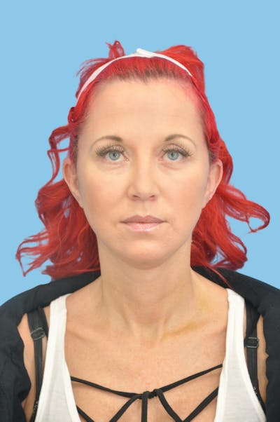 Facelift & Necklift Before & After Gallery - Patient 193546 - Image 2