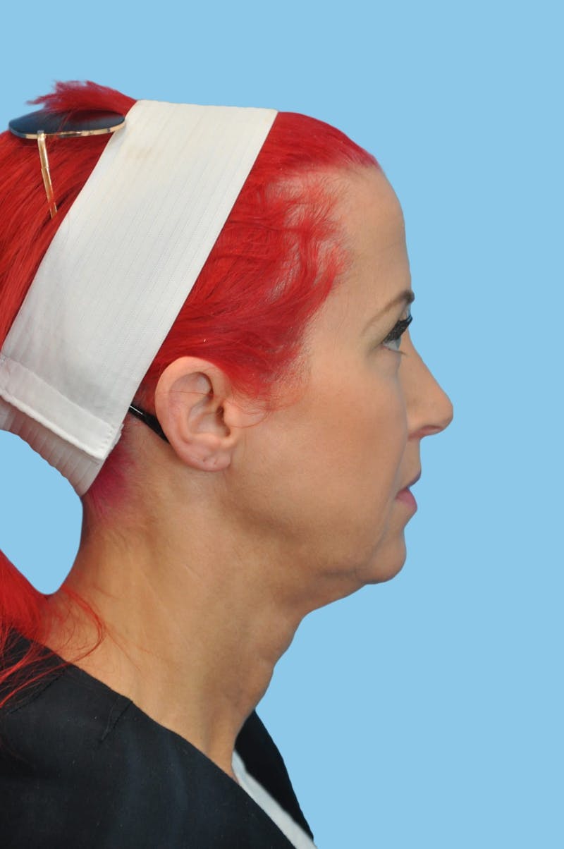 SWIFT LIFT ® / Facelift / Necklift  Before & After Gallery - Patient 193546 - Image 3