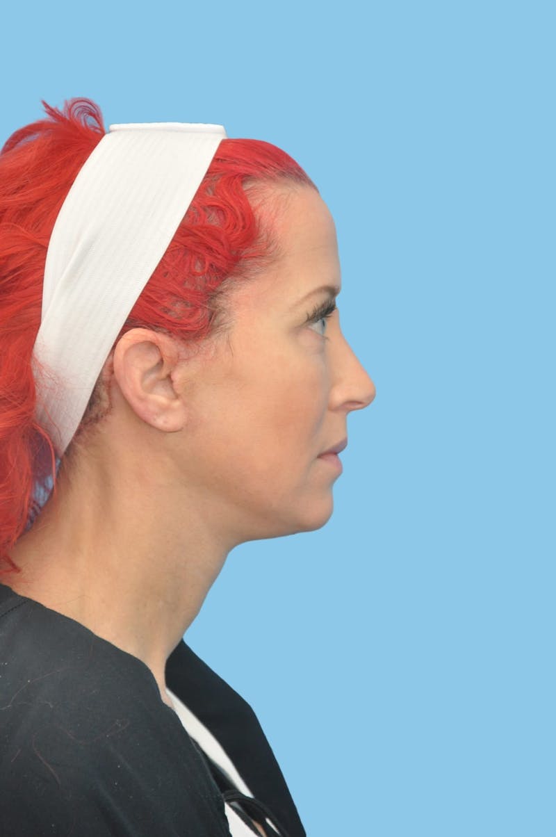 Facelift & Necklift Before & After Gallery - Patient 193546 - Image 4