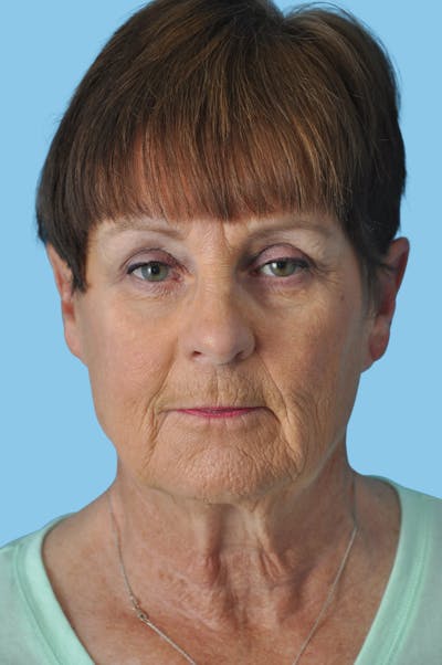 Facelift & Necklift Before & After Gallery - Patient 304080 - Image 1