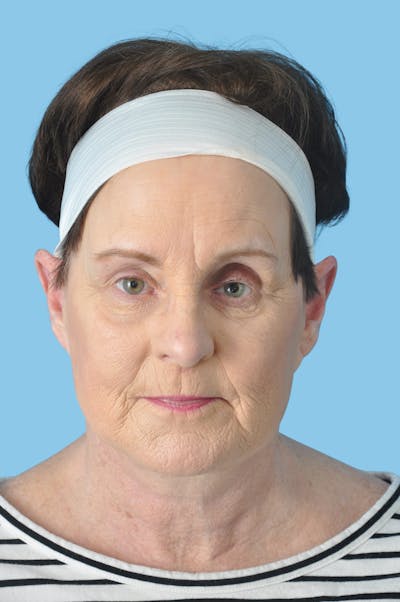 Facelift & Necklift Before & After Gallery - Patient 304080 - Image 2