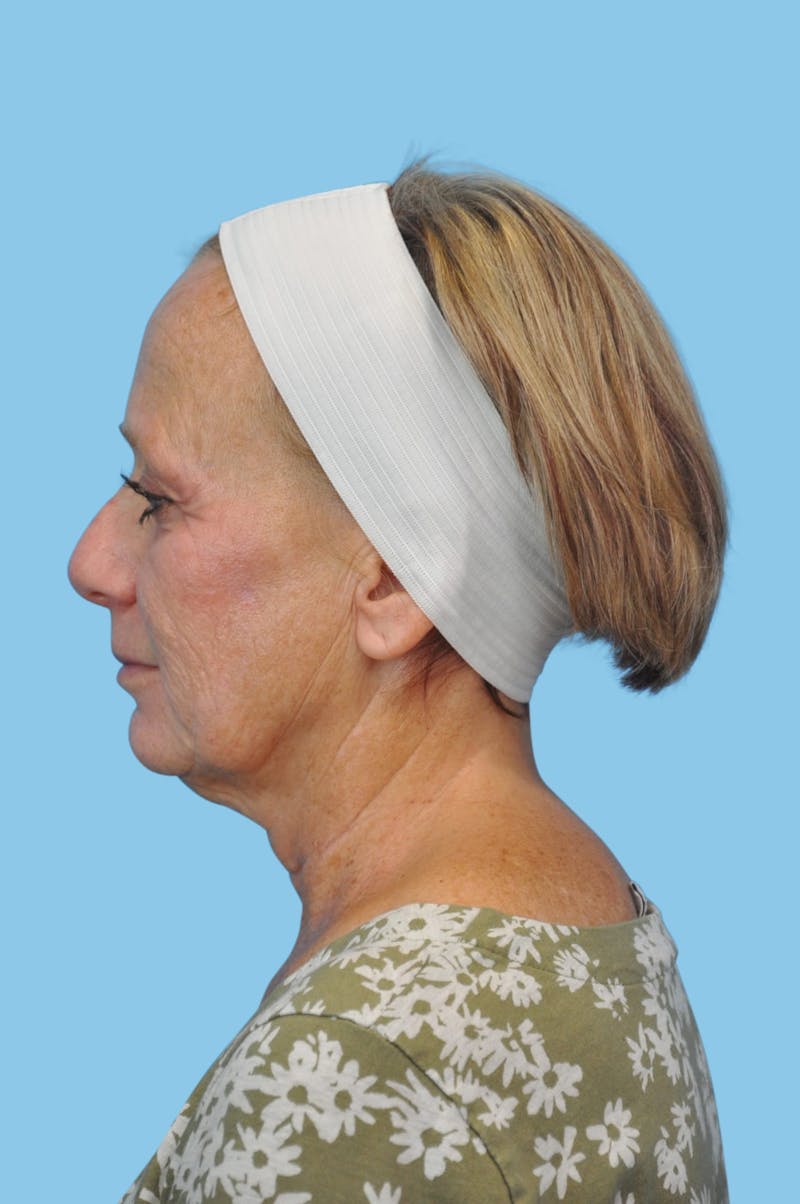 Facelift & Necklift Before & After Gallery - Patient 226064 - Image 1