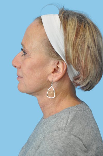 Facelift & Necklift Before & After Gallery - Patient 226064 - Image 2