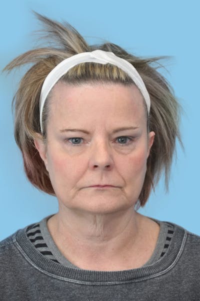 SWIFT LIFT ® / Facelift / Necklift  Before & After Gallery - Patient 204789 - Image 1
