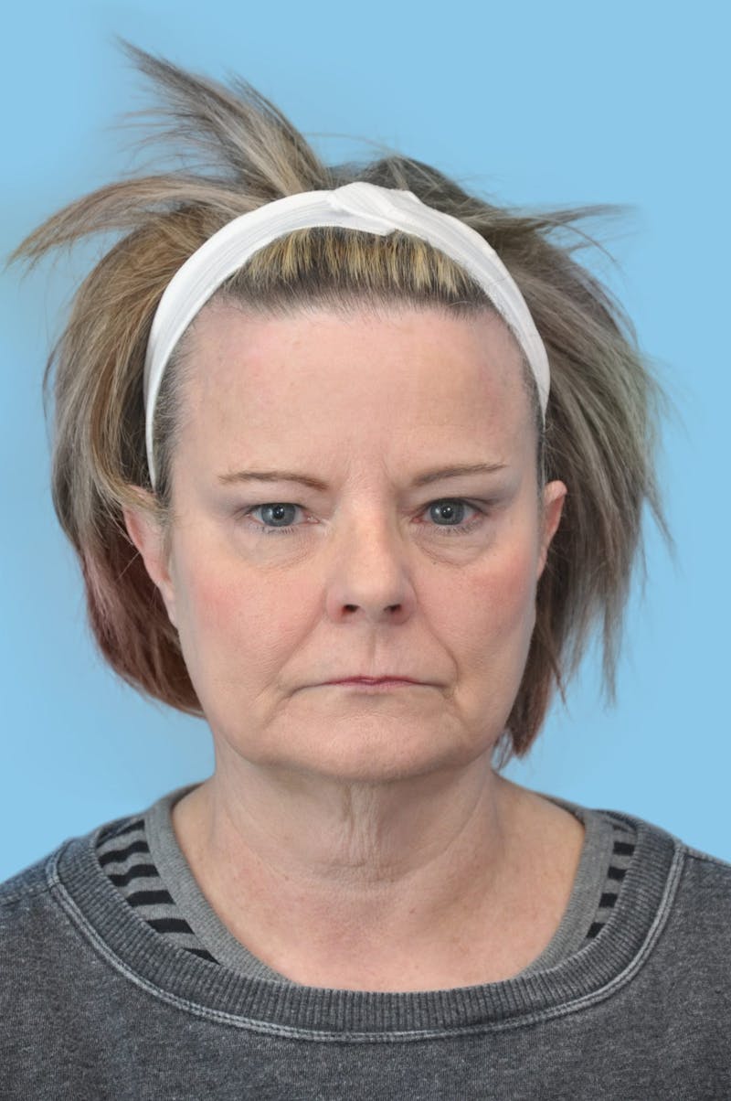 Facelift & Necklift Before & After Gallery - Patient 204789 - Image 1