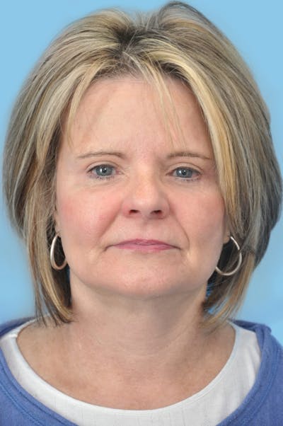 SWIFT LIFT ® / Facelift / Necklift  Before & After Gallery - Patient 204789 - Image 2