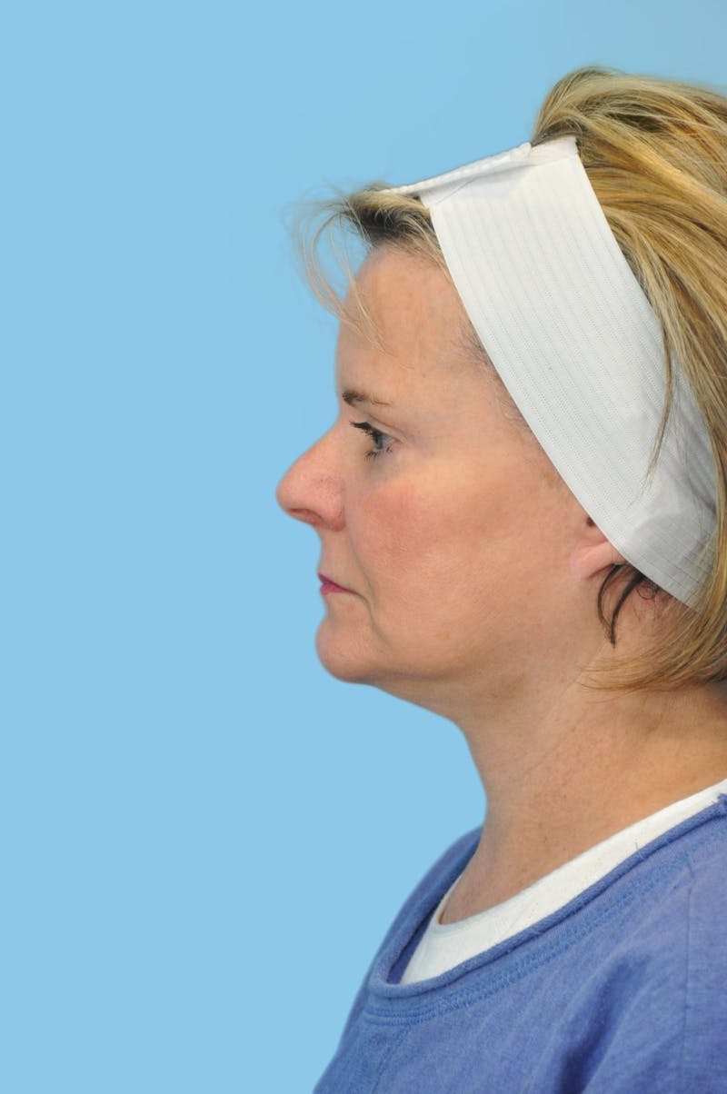 Facelift & Necklift Before & After Gallery - Patient 204789 - Image 4