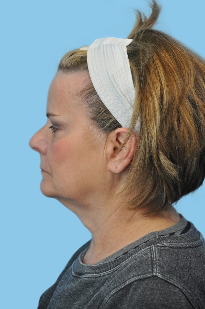 Facelift & Necklift Before & After Gallery - Patient 204789 - Image 3