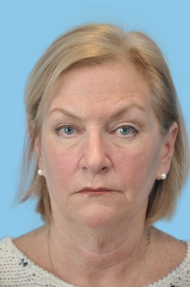 Facelift & Necklift Before & After Gallery - Patient 230509 - Image 1