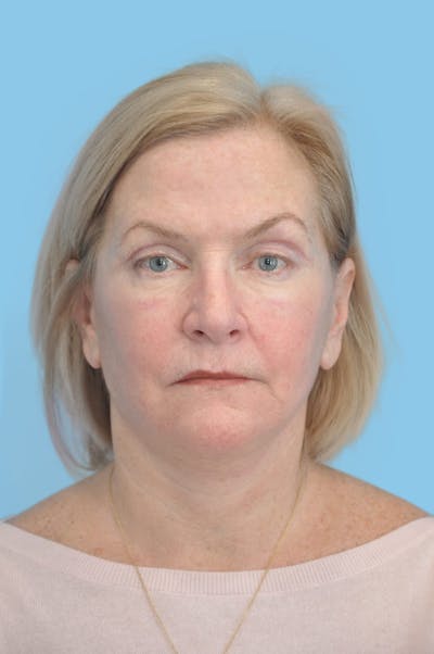 Facelift & Necklift Before & After Gallery - Patient 230509 - Image 2