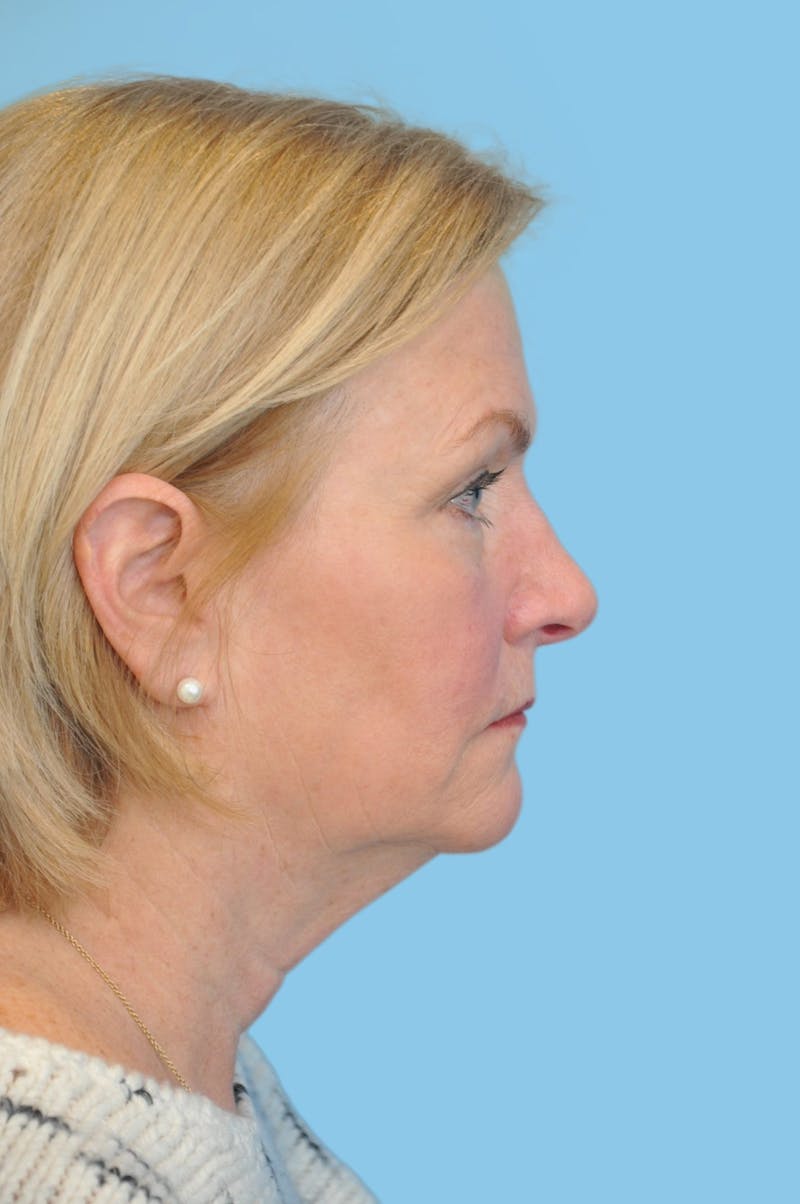 Facelift & Necklift Before & After Gallery - Patient 230509 - Image 3