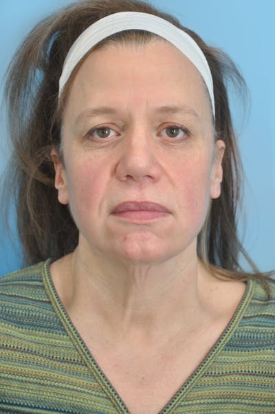 Facelift & Necklift Before & After Gallery - Patient 101352 - Image 1