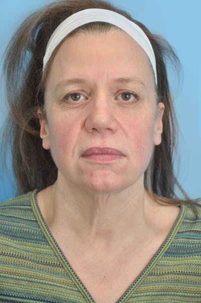 SWIFT LIFT ® / Facelift / Necklift  Before & After Gallery - Patient 101352 - Image 1