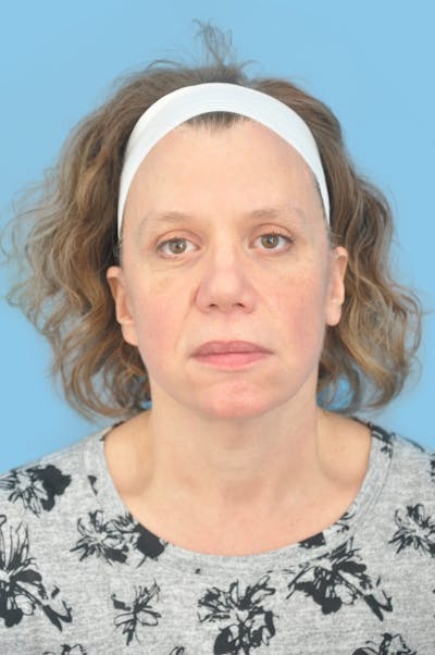Facelift & Necklift Before & After Gallery - Patient 101352 - Image 2