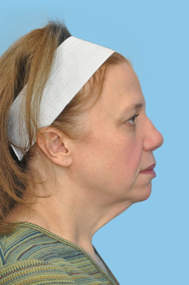 SWIFT LIFT ® / Facelift / Necklift  Before & After Gallery - Patient 101352 - Image 3