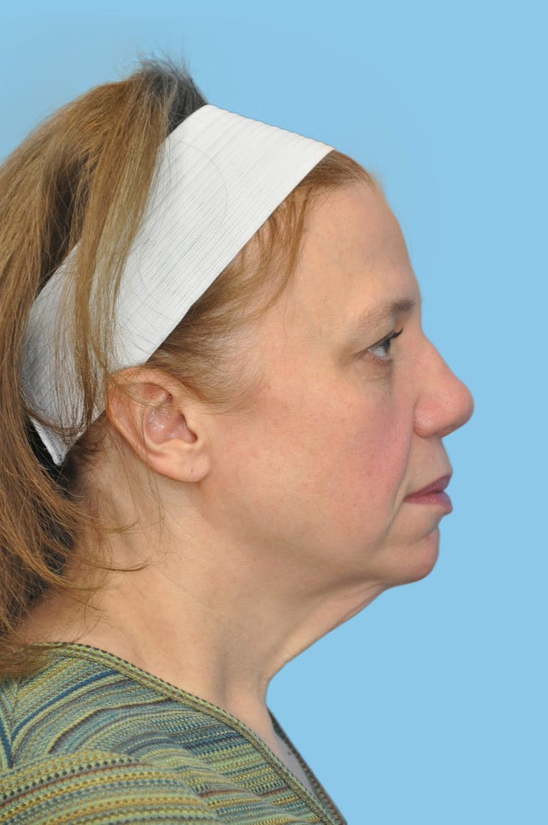 Facelift & Necklift Before & After Gallery - Patient 101352 - Image 3