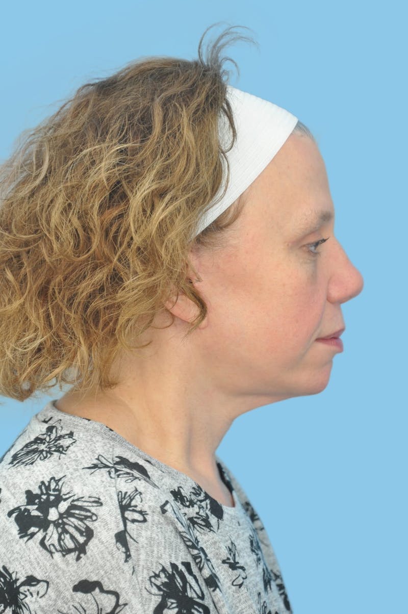 Facelift & Necklift Before & After Gallery - Patient 101352 - Image 4