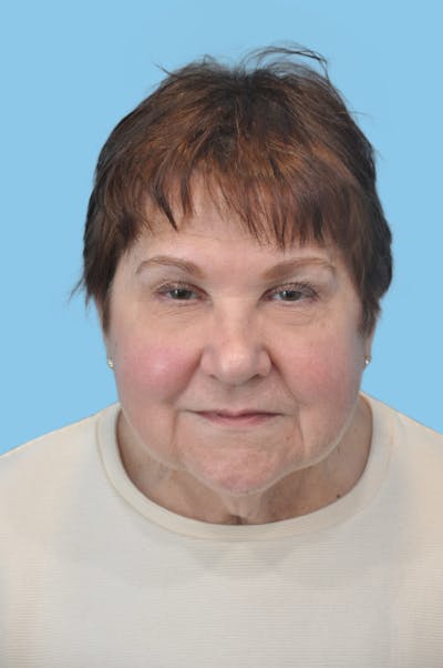 Facelift & Necklift Before & After Gallery - Patient 125564 - Image 1