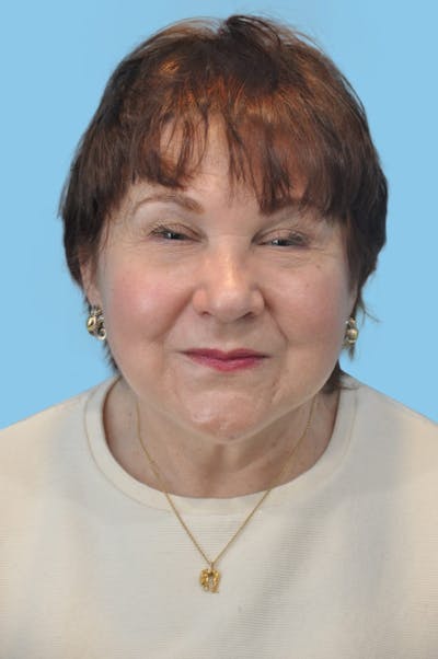 Facelift & Necklift Before & After Gallery - Patient 125564 - Image 2