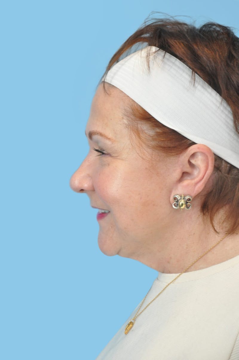 Facelift & Necklift Before & After Gallery - Patient 125564 - Image 4
