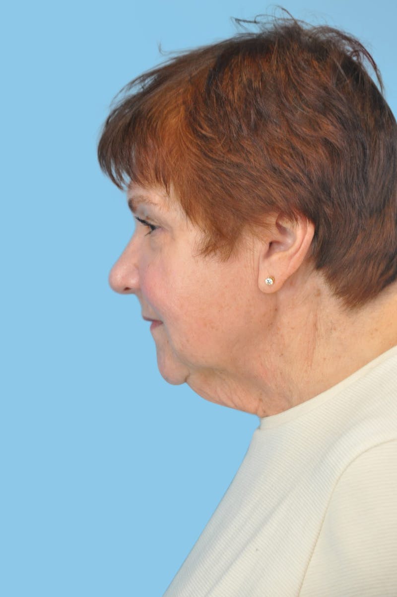 Facelift & Necklift Before & After Gallery - Patient 125564 - Image 3