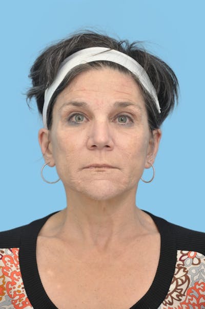 SWIFT LIFT ® / Facelift / Necklift  Before & After Gallery - Patient 164126 - Image 2