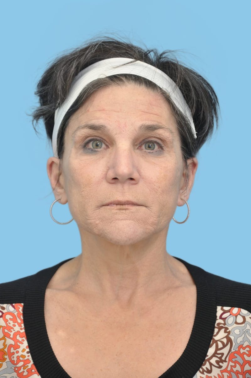 Facelift & Necklift Before & After Gallery - Patient 164126 - Image 2