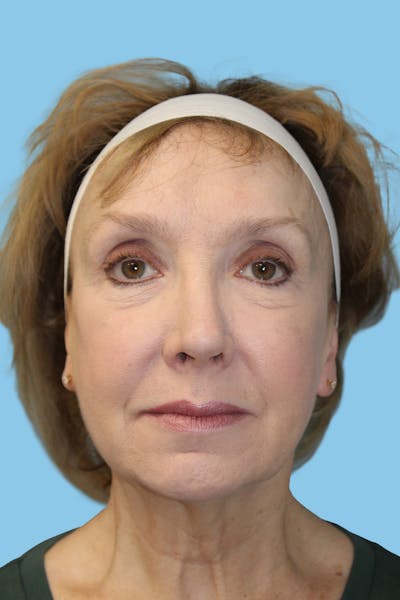 Facelift & Necklift Before & After Gallery - Patient 174101 - Image 1