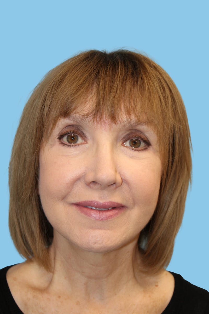 Facelift & Necklift Before & After Gallery - Patient 174101 - Image 2