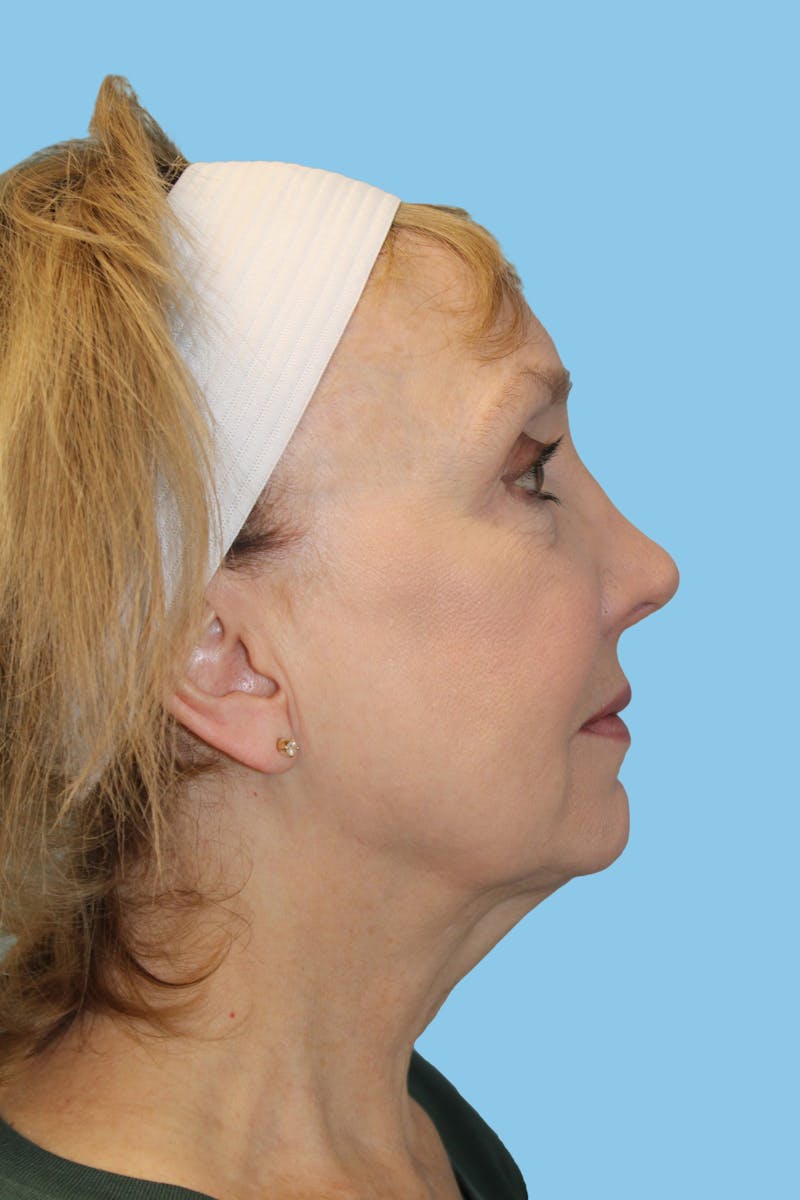 Facelift & Necklift Before & After Gallery - Patient 174101 - Image 3