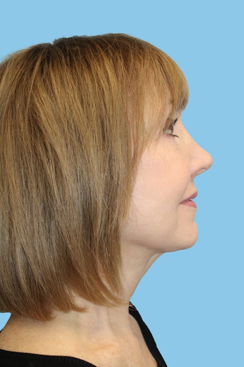 Facelift & Necklift Before & After Gallery - Patient 174101 - Image 4