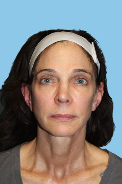 Facelift & Necklift Before & After Gallery - Patient 364436 - Image 2