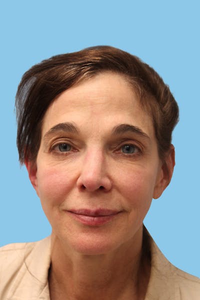 SWIFT LIFT ® / Facelift / Necklift  Before & After Gallery - Patient 364436 - Image 1