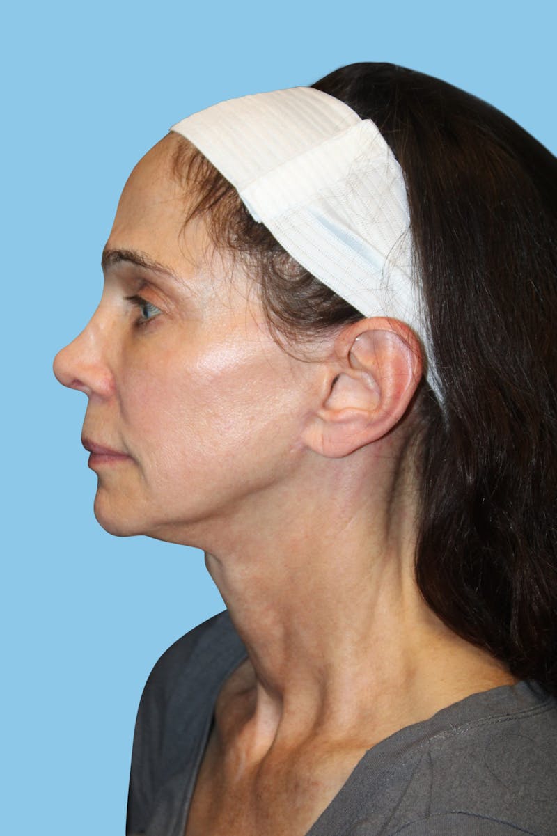 Facelift & Necklift Before & After Gallery - Patient 364436 - Image 4