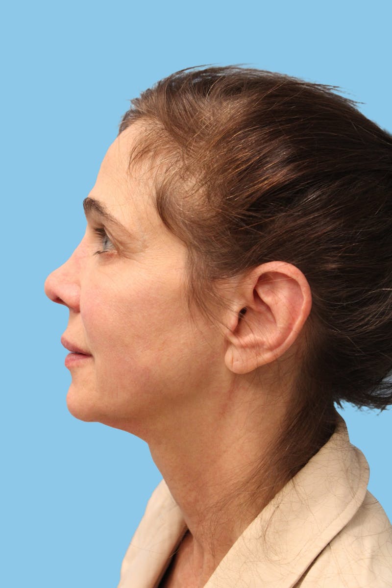 Facelift & Necklift Before & After Gallery - Patient 364436 - Image 3