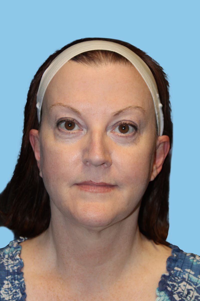 SWIFT LIFT ® / Facelift / Necklift  Before & After Gallery - Patient 965174 - Image 2