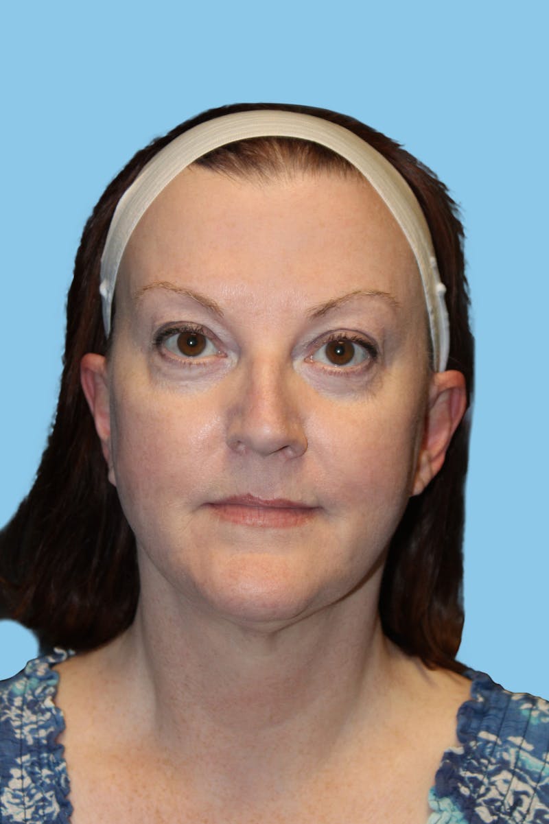 Facelift & Necklift Before & After Gallery - Patient 965174 - Image 2