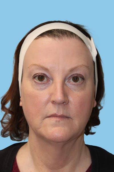 Facelift & Necklift Before & After Gallery - Patient 965174 - Image 1