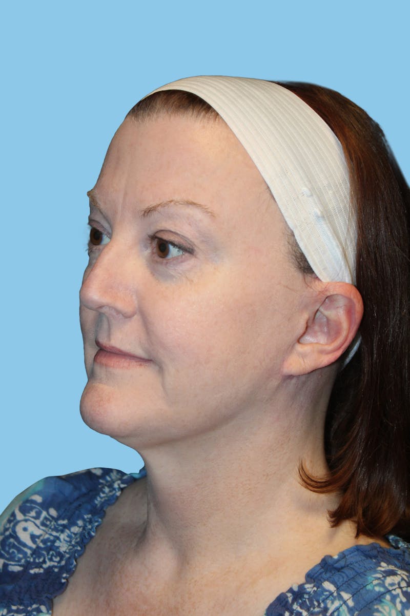 Facelift & Necklift Before & After Gallery - Patient 965174 - Image 4