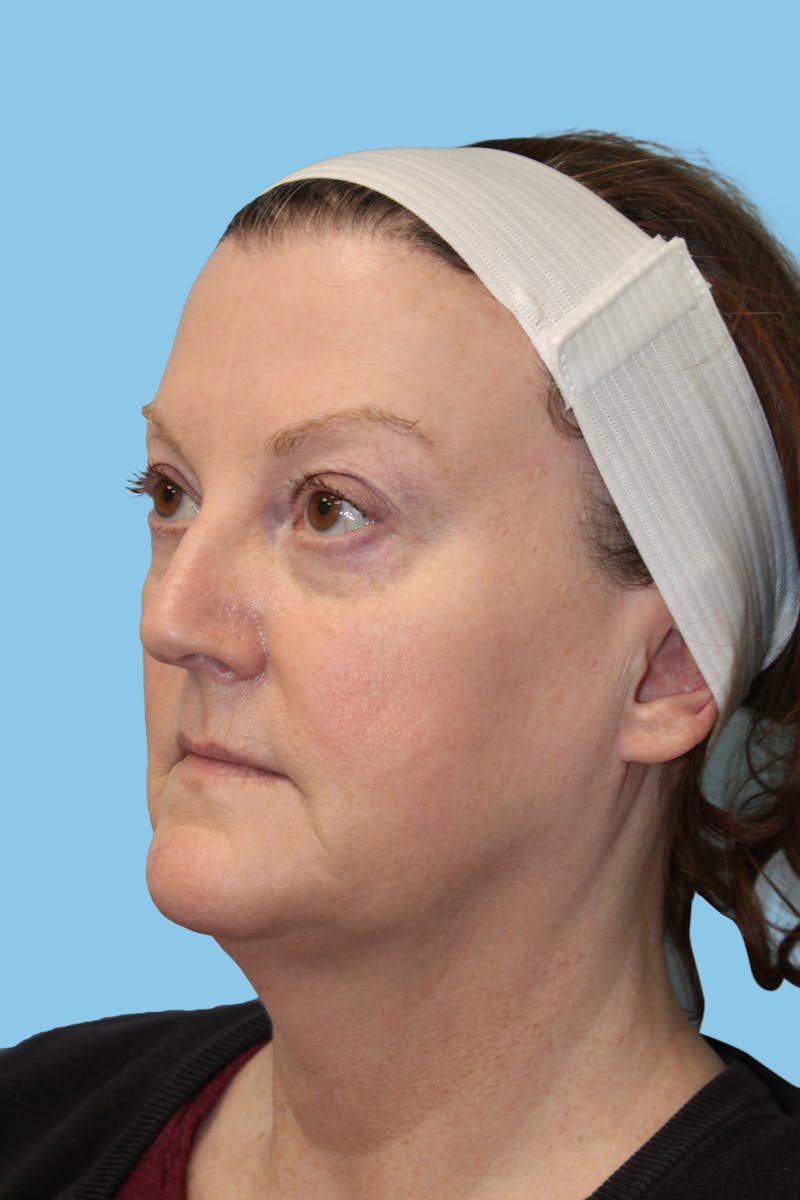 Facelift & Necklift Before & After Gallery - Patient 965174 - Image 3